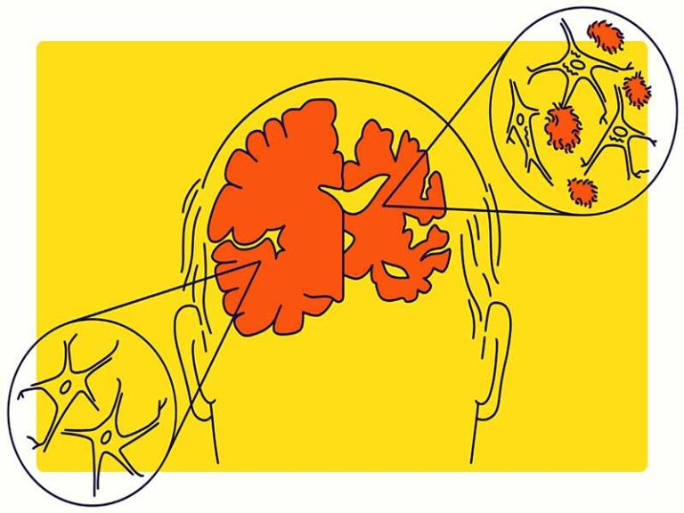 دانلود کتاب مقالات بیماری آلزایمر